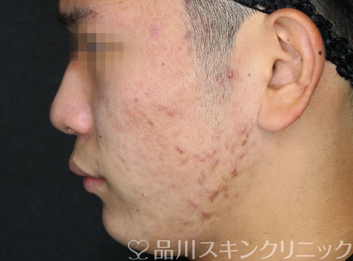 症例NO.63845のAFTER写真