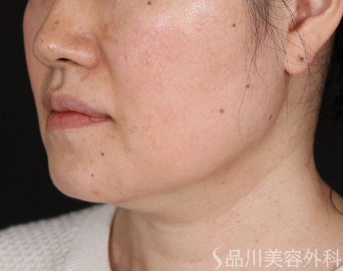 症例NO.70806のBEFORE写真