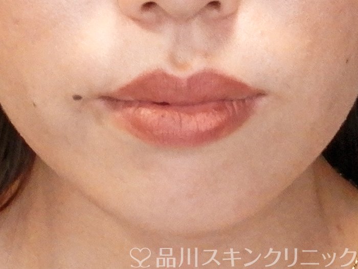 症例NO.65348のBEFORE写真