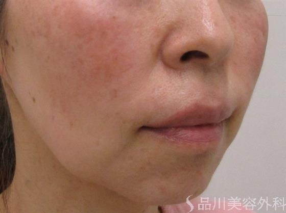 症例NO.43619のBEFORE写真