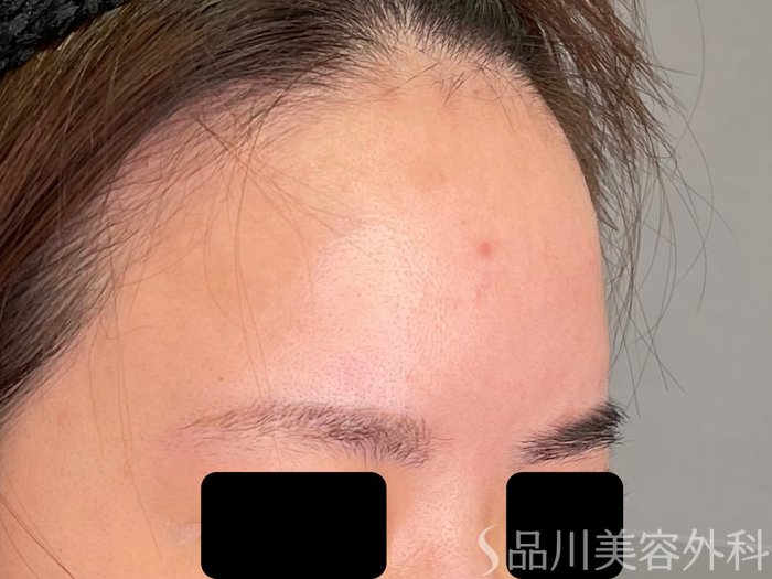 症例NO.71423のAFTER写真