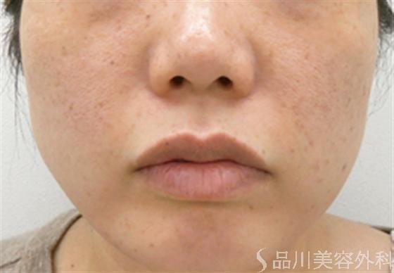 症例NO.18138のAFTER写真