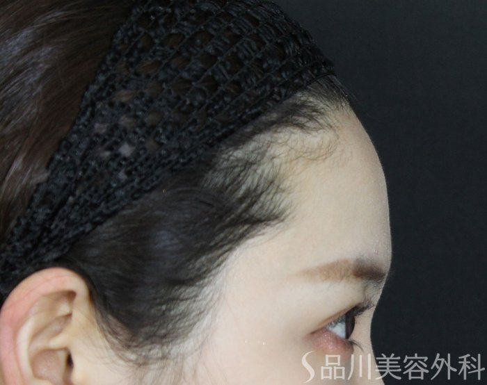 症例NO.73487のBEFORE写真