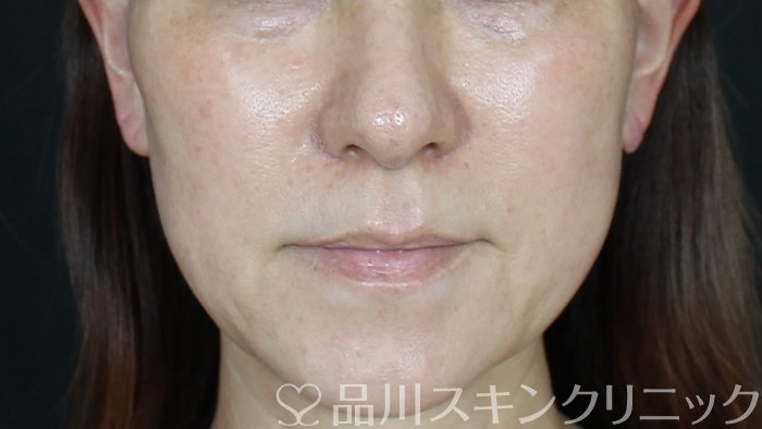 症例NO.71199のBEFORE写真