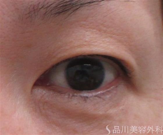 症例NO.23203のBEFORE写真