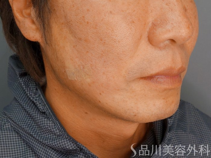 症例NO.70039のAFTER写真