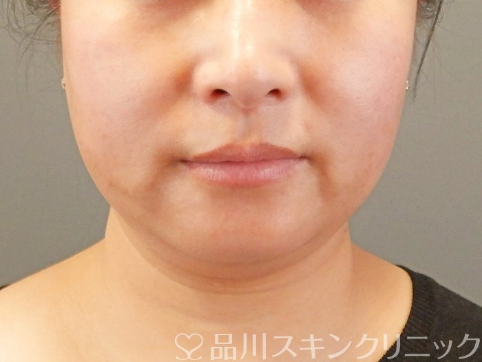 症例NO.63669のBEFORE写真