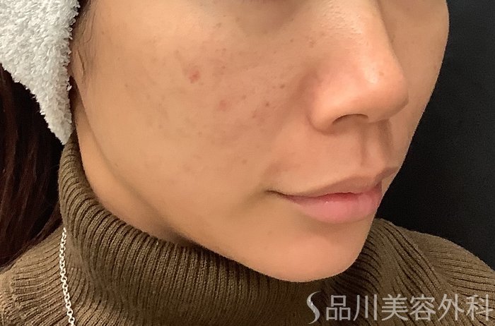 症例NO.67961のAFTER写真