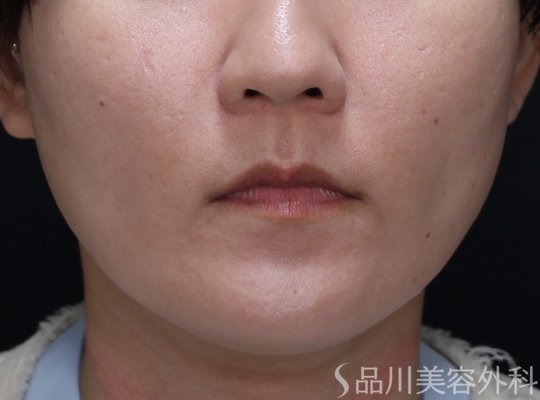 症例NO.74046のAFTER写真