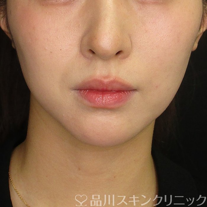 症例NO.70140のAFTER写真