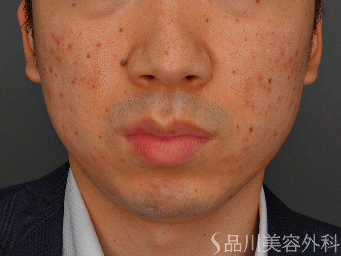症例NO.75252のBEFORE写真