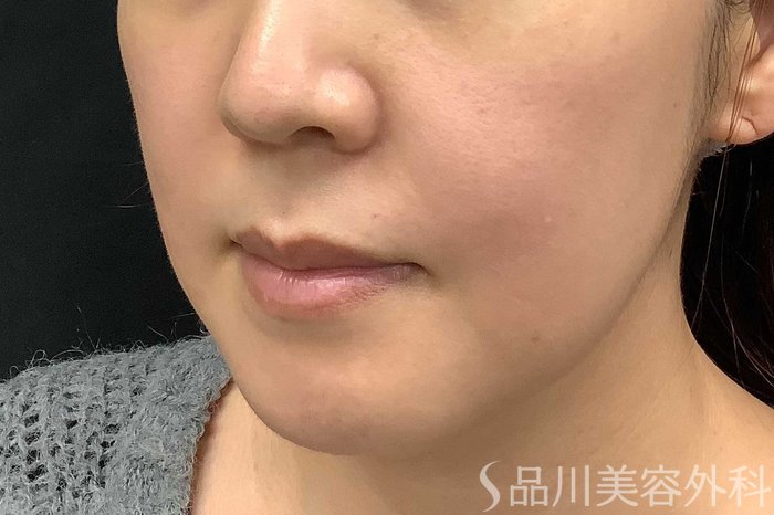 症例NO.63013のBEFORE写真