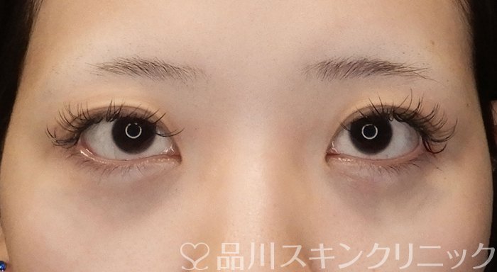 症例NO.66285のAFTER写真