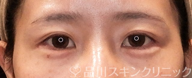 症例NO.70551のAFTER写真