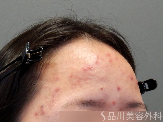 症例NO.69797のBEFORE写真
