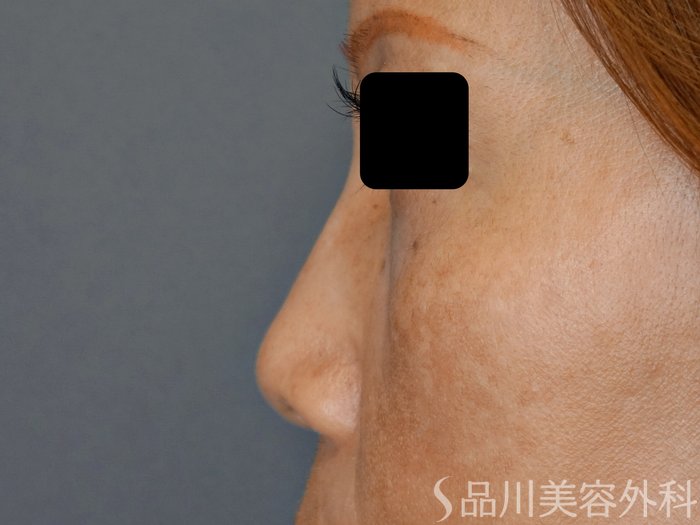 症例NO.71498のBEFORE写真