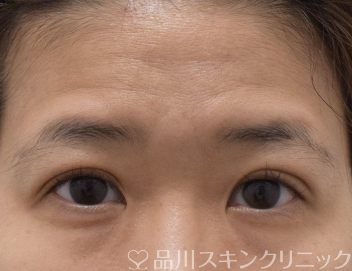 症例NO.73103のAFTER写真