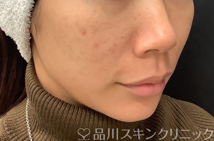 症例NO.67961のAFTER写真