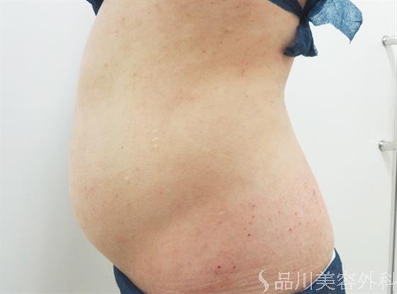 症例NO.23405のBEFORE写真