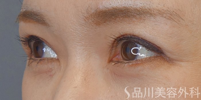 症例NO.72104のAFTER写真