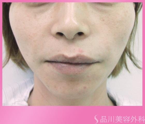 症例NO.1171のAFTER写真