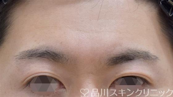 症例NO.59325のBEFORE写真