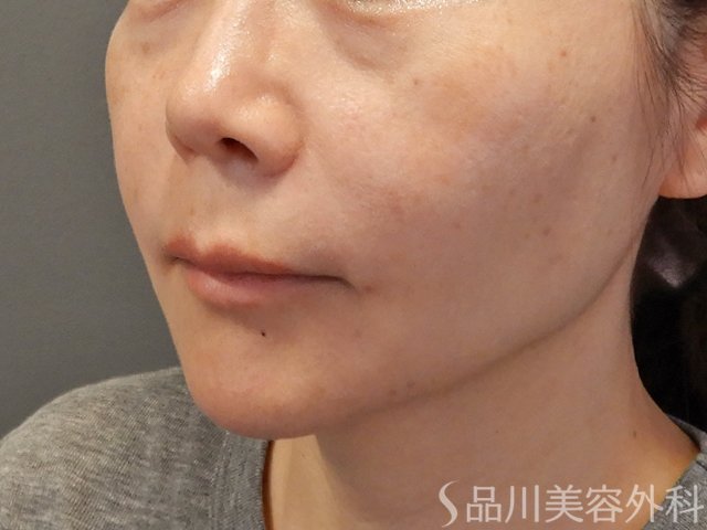 症例NO.74471のBEFORE写真