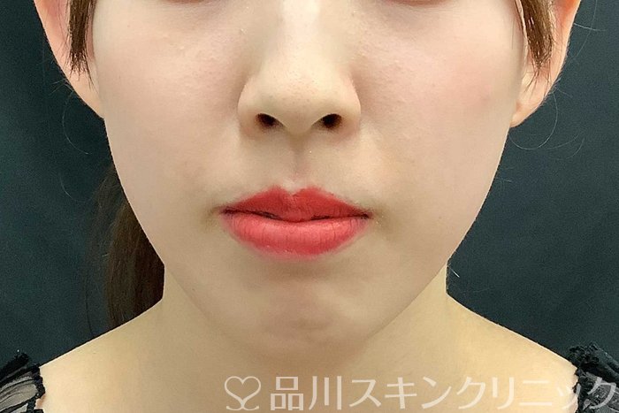 症例NO.69705のBEFORE写真