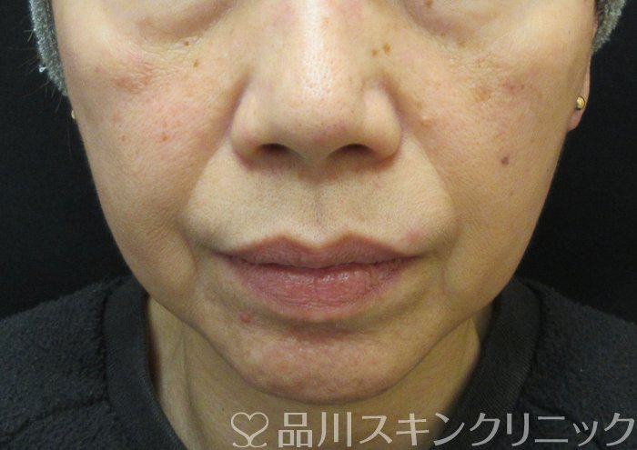 症例NO.74186のBEFORE写真