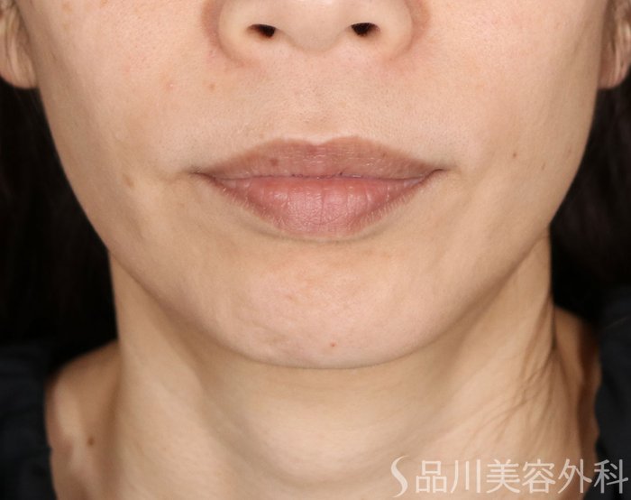 症例NO.74122のBEFORE写真