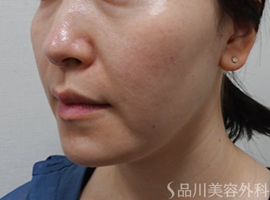 症例NO.75175のBEFORE写真