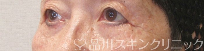 症例NO.75343のAFTER写真
