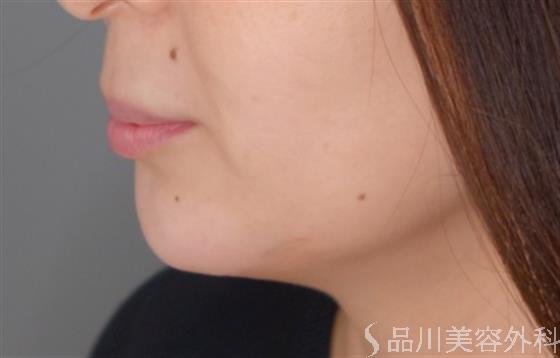 症例NO.52331のAFTER写真