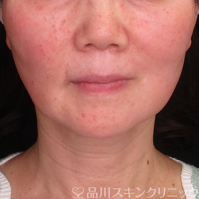 症例NO.70057のBEFORE写真
