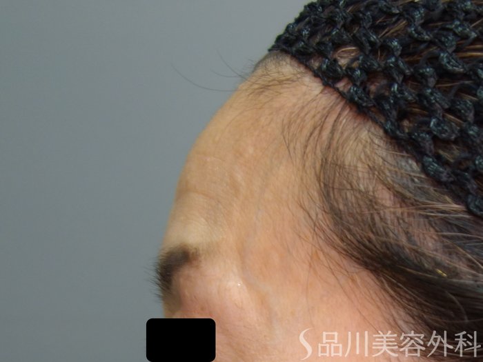 症例NO.70541のBEFORE写真