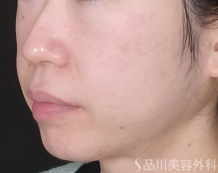 症例NO.69656のBEFORE写真