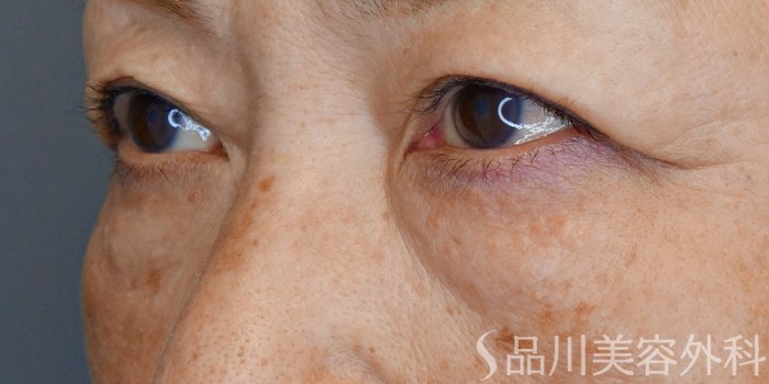 症例NO.72302のBEFORE写真