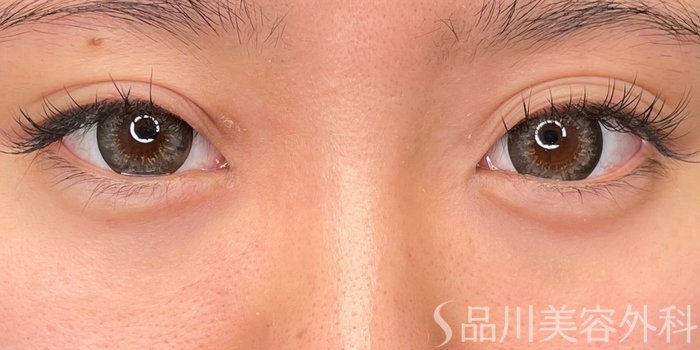 症例NO.65512のAFTER写真