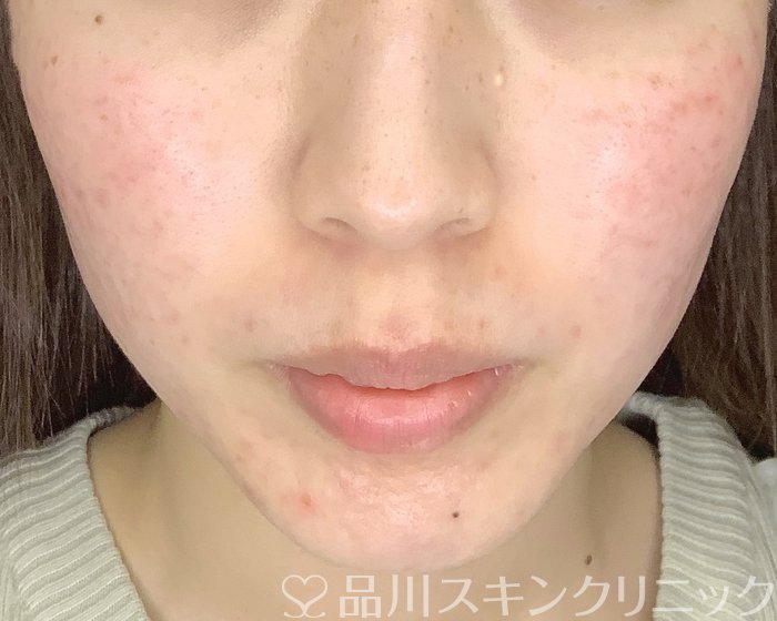症例NO.70267のAFTER写真