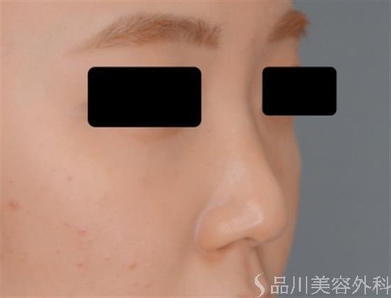 症例NO.54902のBEFORE写真