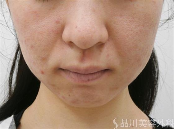 症例NO.30674のAFTER写真