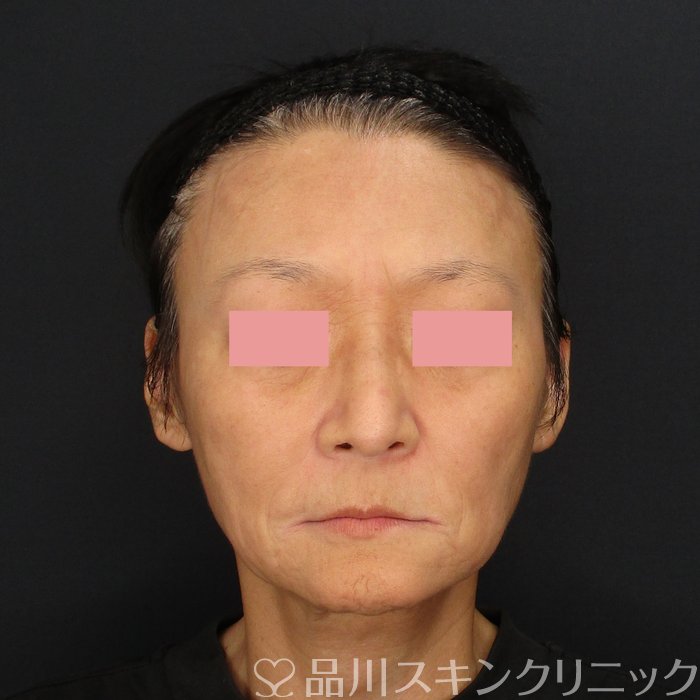 症例NO.71884のBEFORE写真