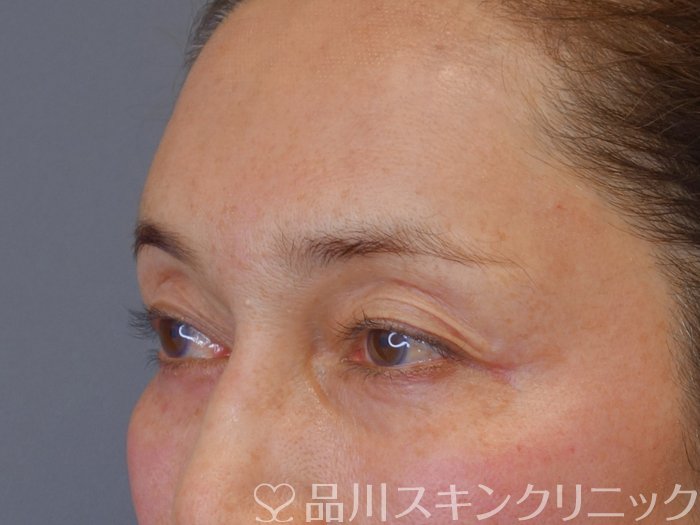 症例NO.73350のAFTER写真