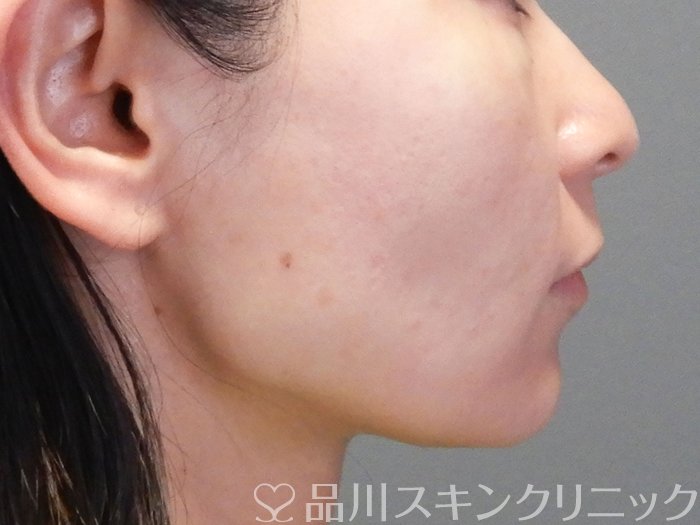 症例NO.74371のAFTER写真