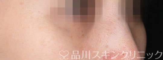 症例NO.75355のAFTER写真