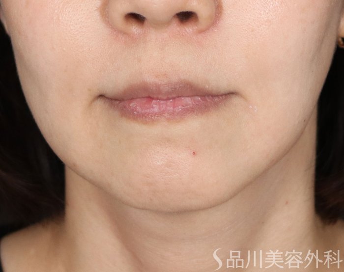 症例NO.71588のAFTER写真
