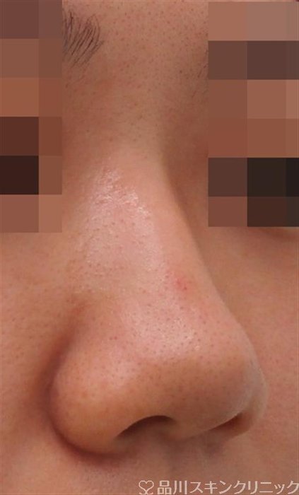 症例NO.38026のBEFORE写真