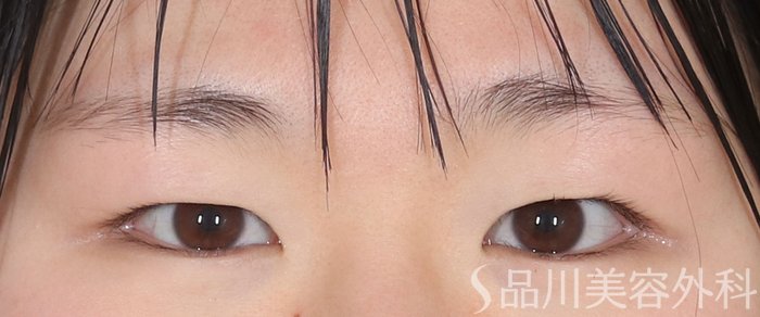 症例NO.72924のBEFORE写真