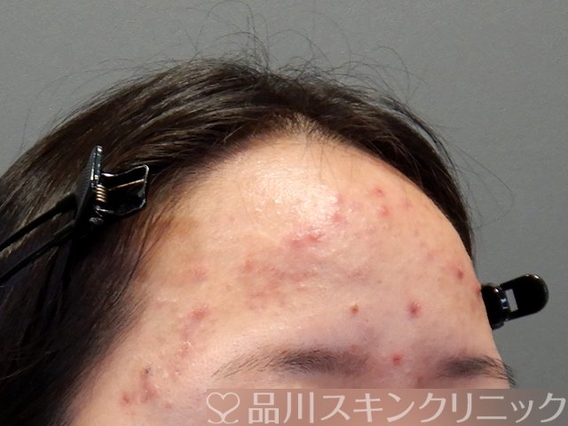 症例NO.69797のBEFORE写真