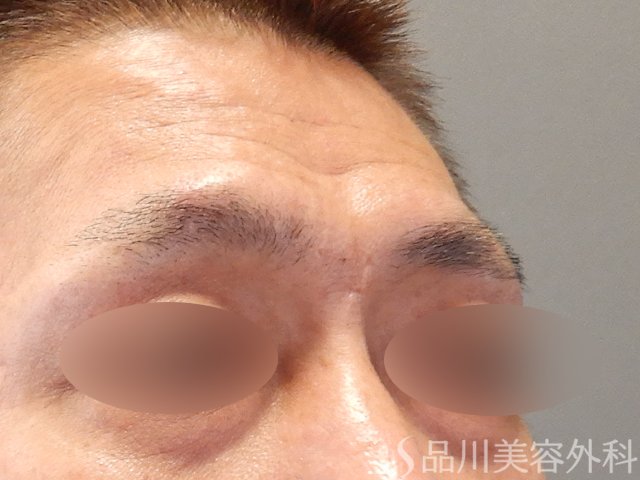症例NO.75248のBEFORE写真